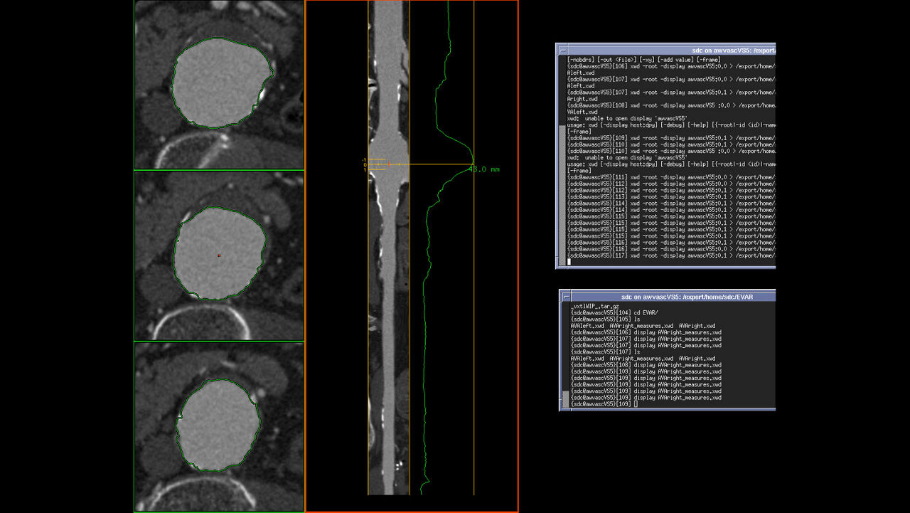 vanced-visualization-applications-tevar-assist-image-gallery-aw-tevar-assist-clinical2