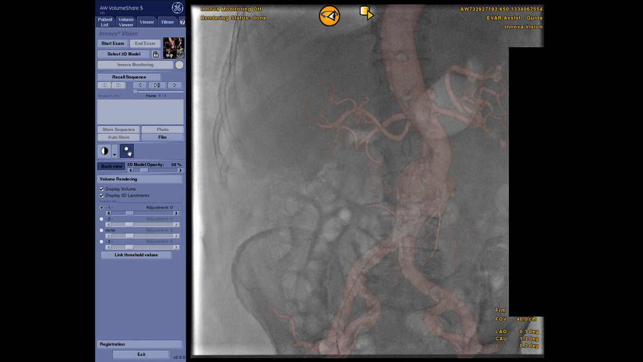 vanced-visualization-applications-tevar-assist-image-gallery-aw-tevar-assist-clinical3