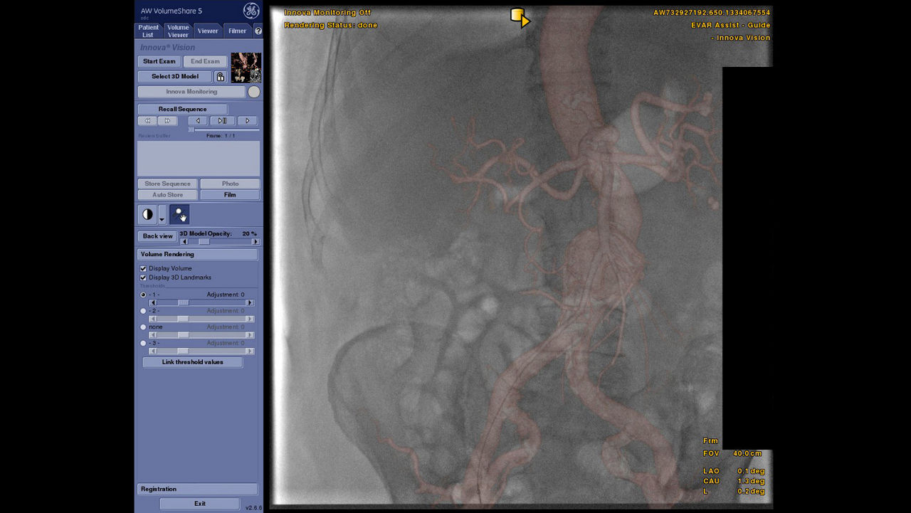 vanced-visualization-applications-tevar-assist-image-gallery-aw-tevar-assist-clinical4