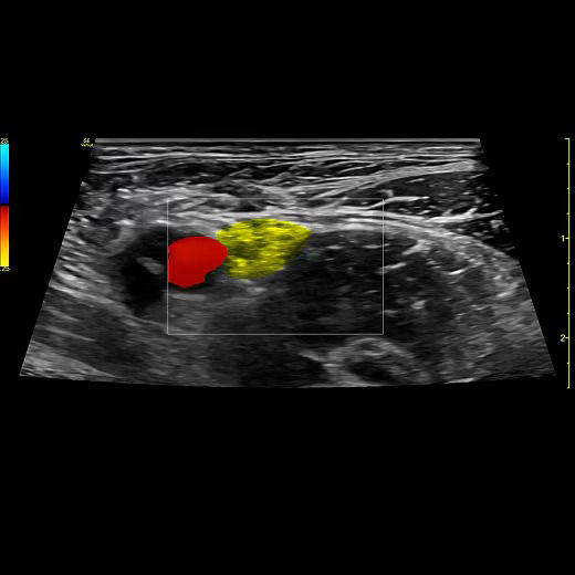 venue-point-of-nerve-block-card1v2-ci-en