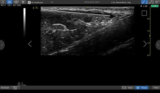 venue-point-of-nerve-block-card3-ci-en
