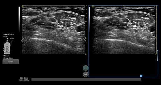 venue-point-of-nerve-block-card4-ci-en