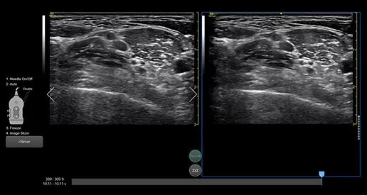 venue-point-of-nerve-block-card4-ci-en