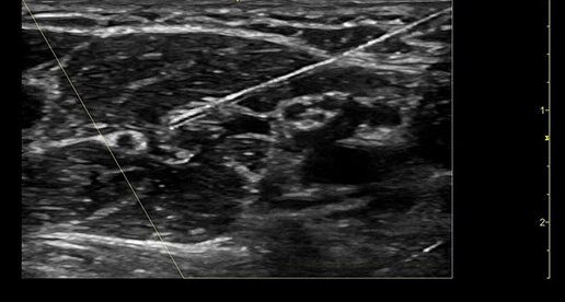 venue-point-of-nerve-block-card5-ci-en