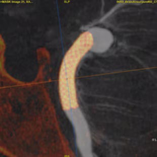 vessel-assist-access-neurointerventional-ci-en