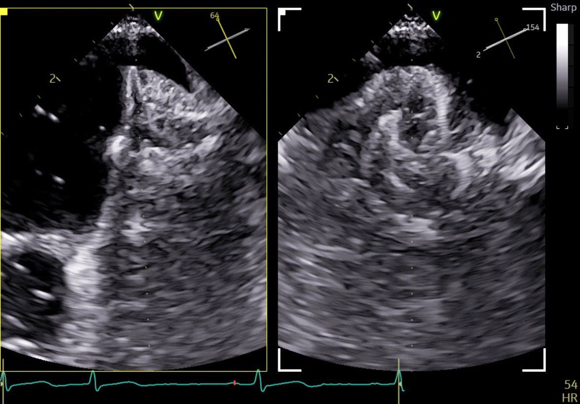 <p>Left Atrial Appendage Closure with 9VT-D</p>
