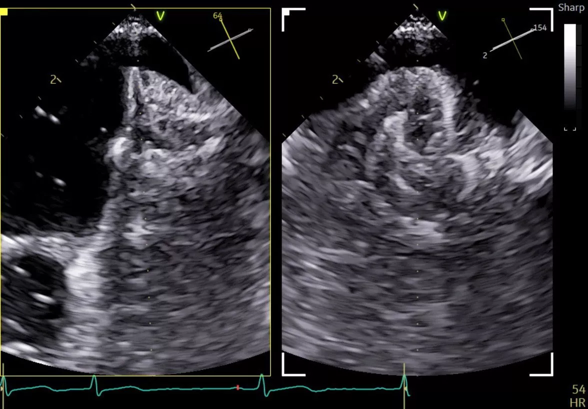 <p>Left Atrial Appendage Closure with 9VT-D</p>
