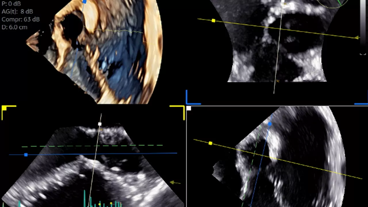 <p>9VT-D mini 3D TEE probe guiding personalized subaortic and aortic valve surgery</p>
