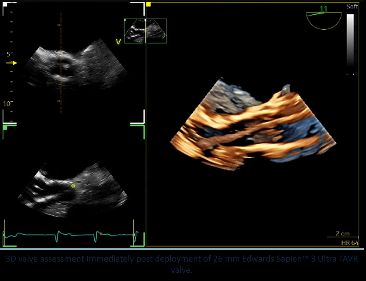 <p>9VT-D mini 3D TEE probe guiding personalized subaortic and aortic valve surgery</p>
