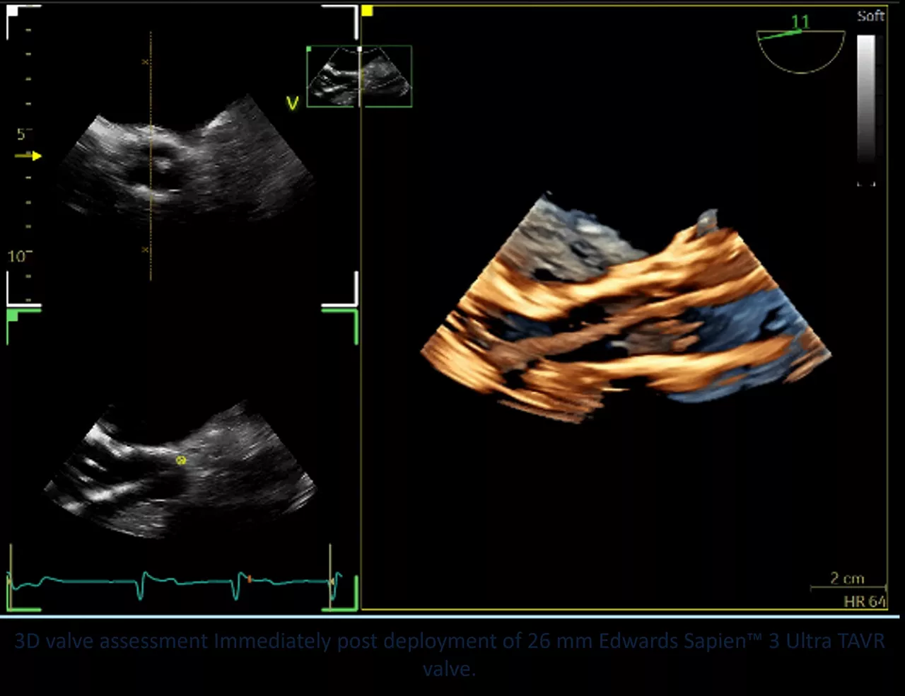 <p>9VT-D mini 3D TEE brings imaging option to patient getting a TAVR from transcarotid approach</p>
