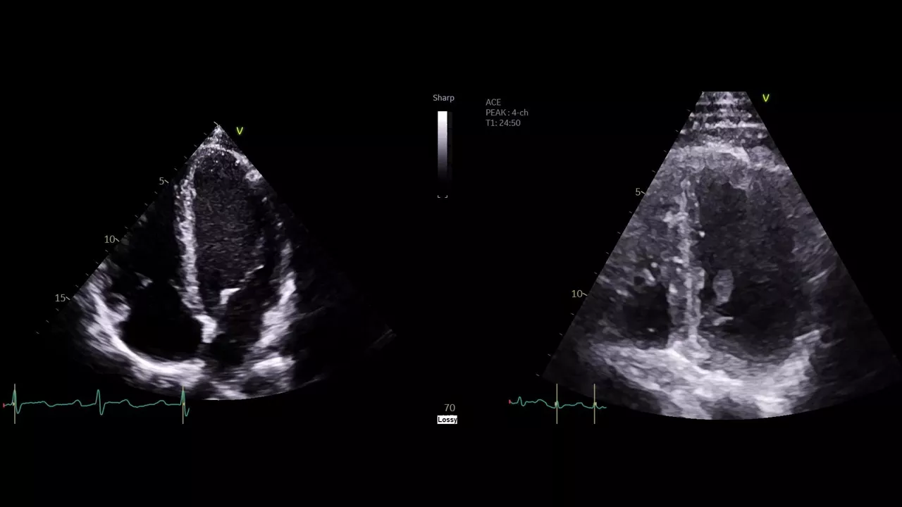<p>Athlete’s heart or dilated cardiomyopathy?</p>
