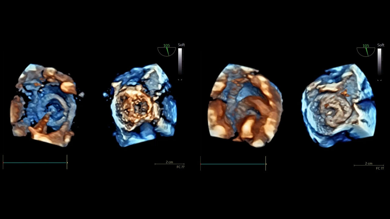 <p>ASD closure in a 6-year-old patient using the 4D mini TEE probe</p>
