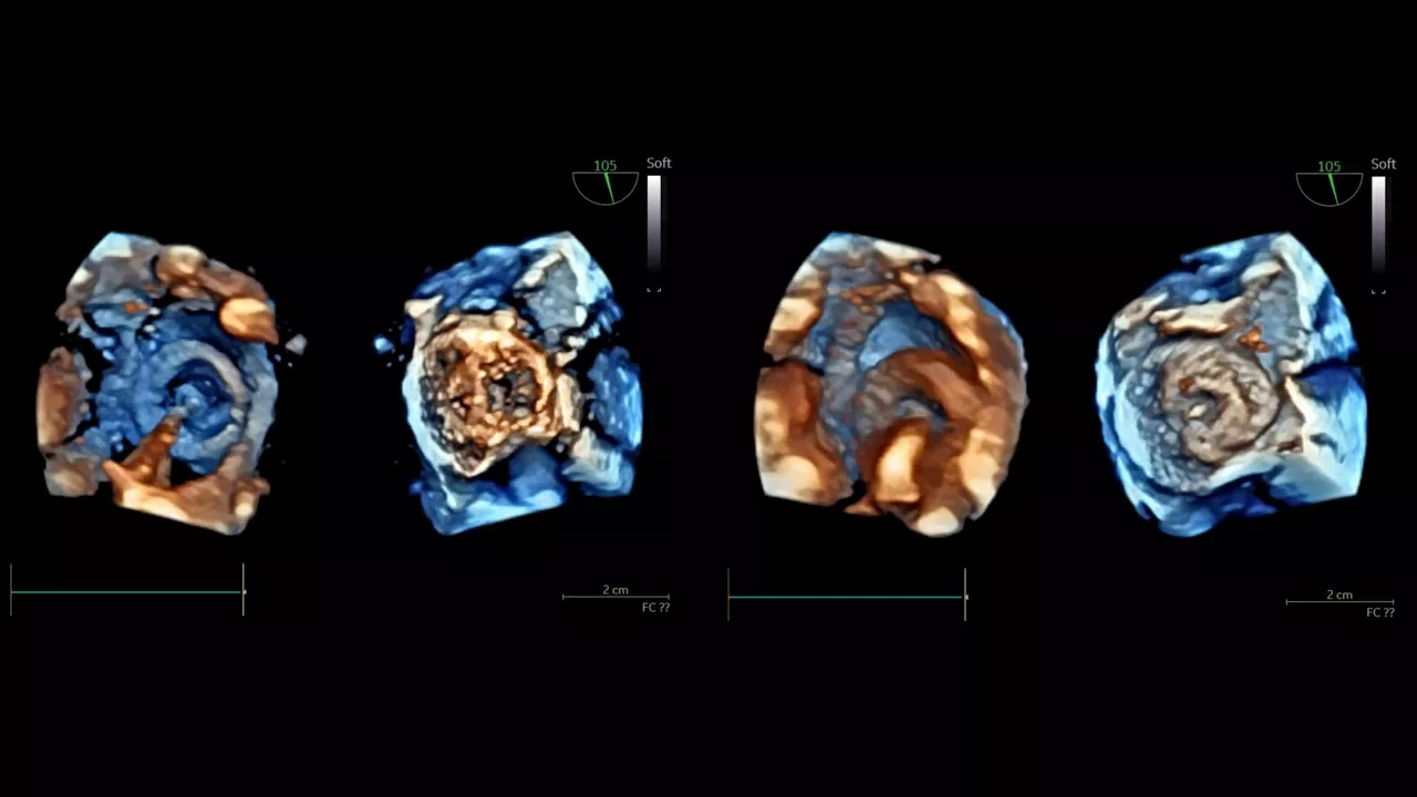 <p>ASD closure in a 6-year-old patient using the 4D mini TEE probe</p>
