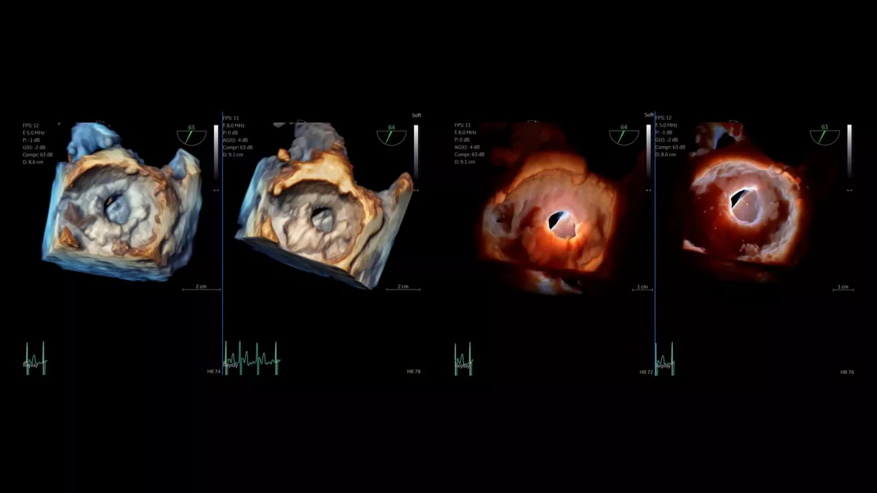 <p>Publication: Initial experience with the 4D mini-TEE probe in the adult population</p>

