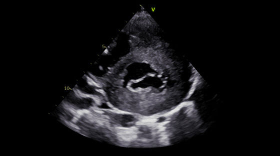 Vivid-S60N-img-004-pediatric-thumbnail