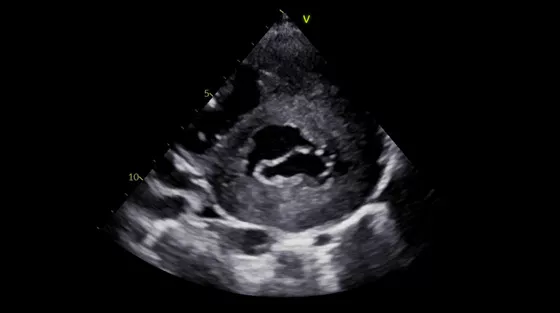 Vivid-S60N-img-004-pediatric-thumbnail