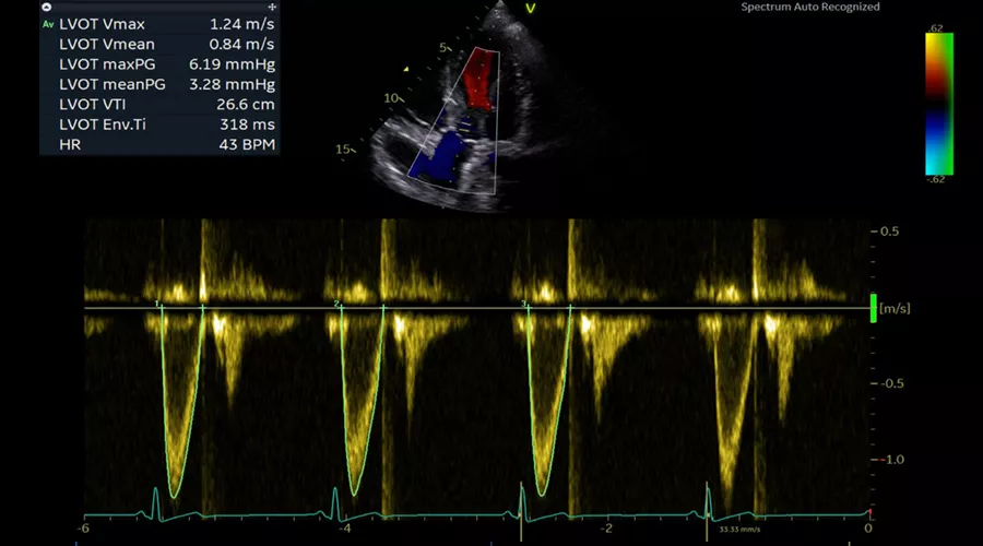 Vivid-S70N-img-003-Auto-Measure-Spectrum-rec