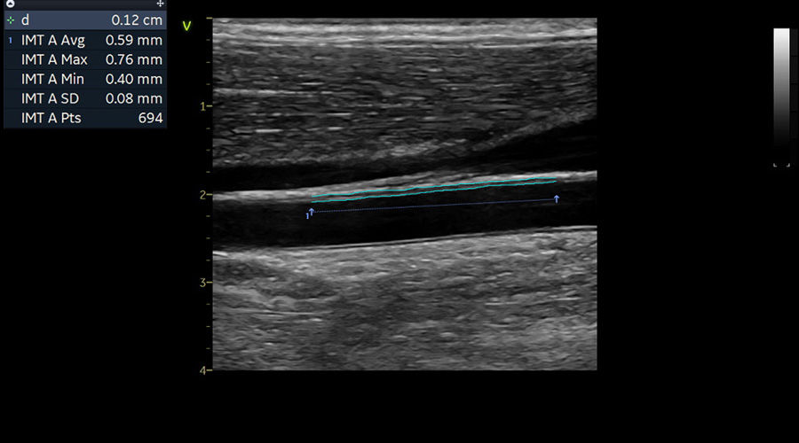 Vivid-S70N-img-008-vascular