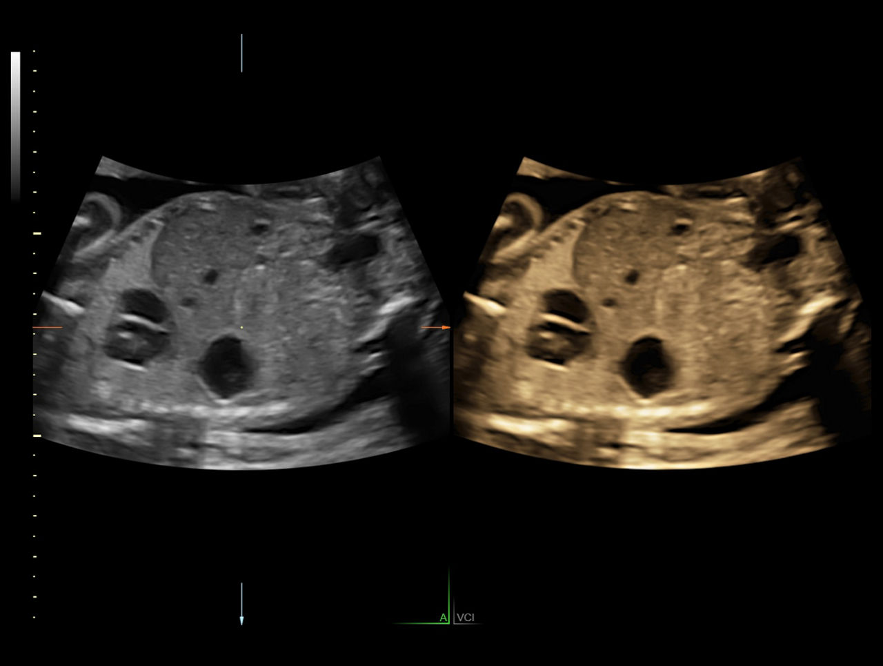 volume-contrast-imaging-vci-ci-en
