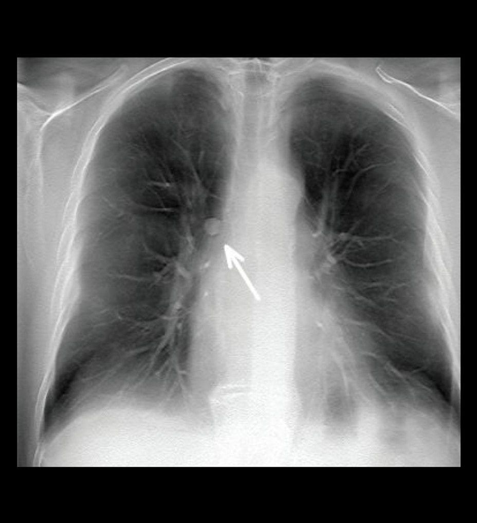volumerad-feature-hero-lung-module-detection-st-en