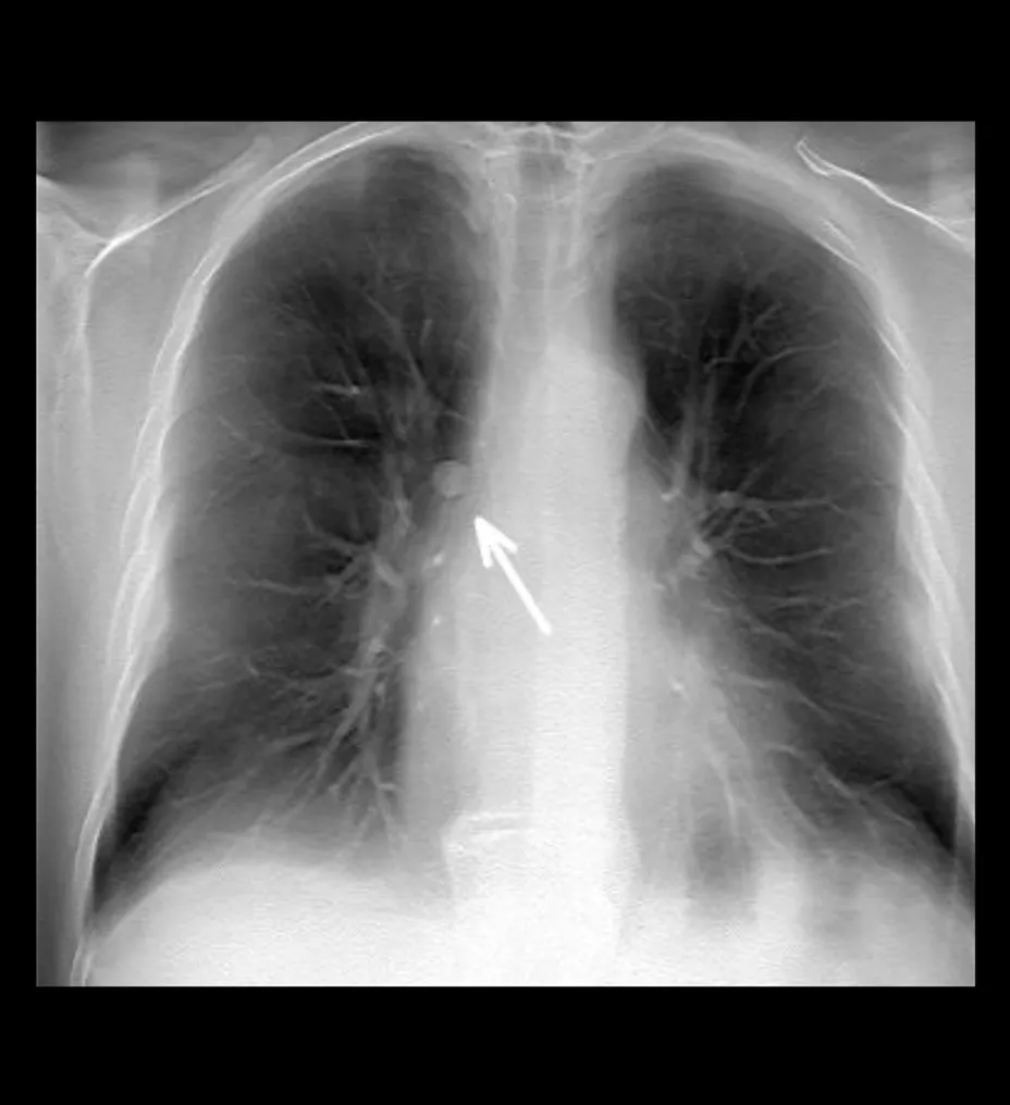 volumerad-feature-hero-lung-module-detection-st-en