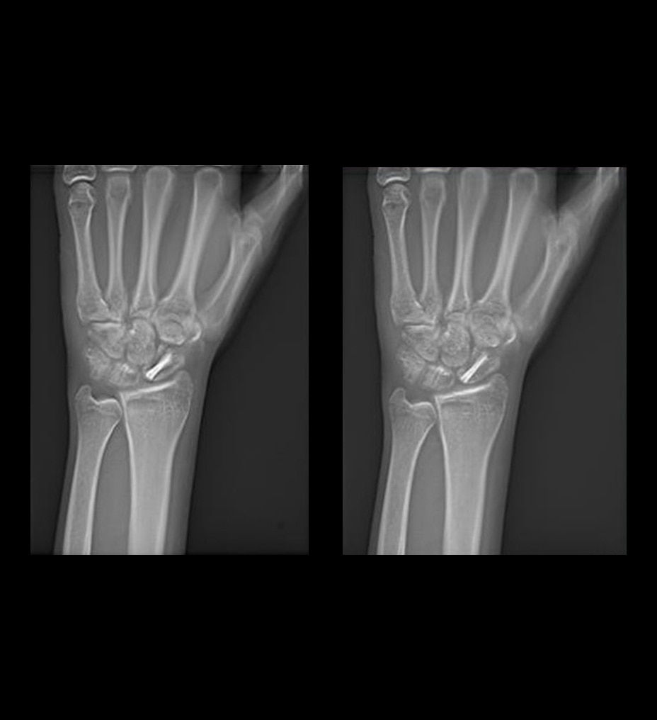 volumerad-feature-hero-metal-implant-st-en