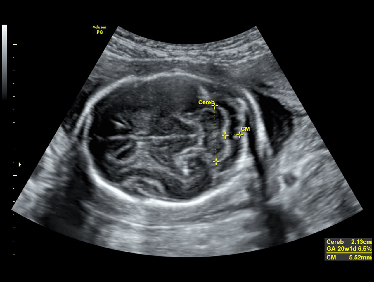 voluson-P8-technology-sonobio-ci-en