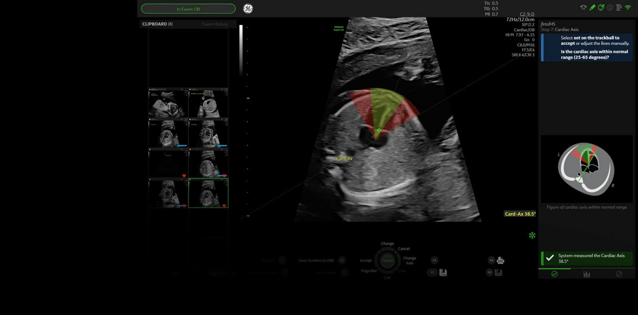 voluson-expert-18-fetal-hs-st-en