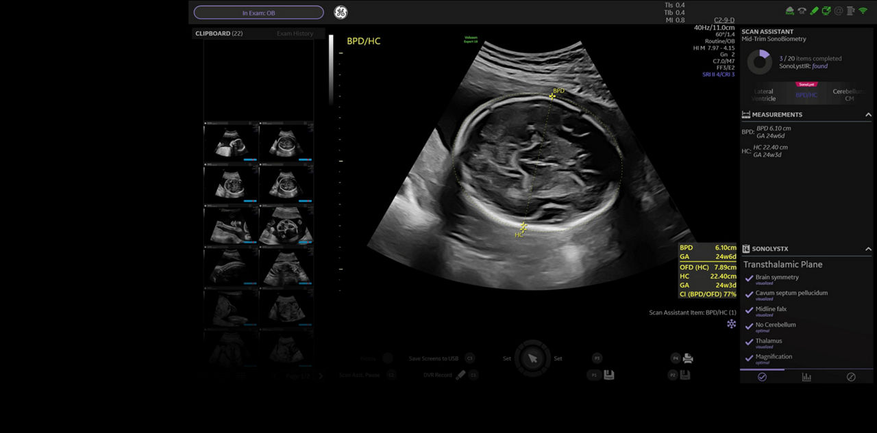 voluson-expert-18-sono-lyst-st-en