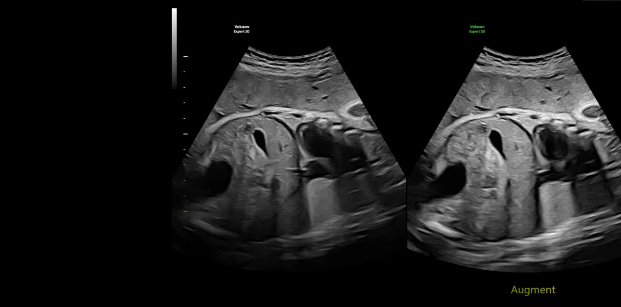 voluson-expert-20-imaging-augment-ci-en