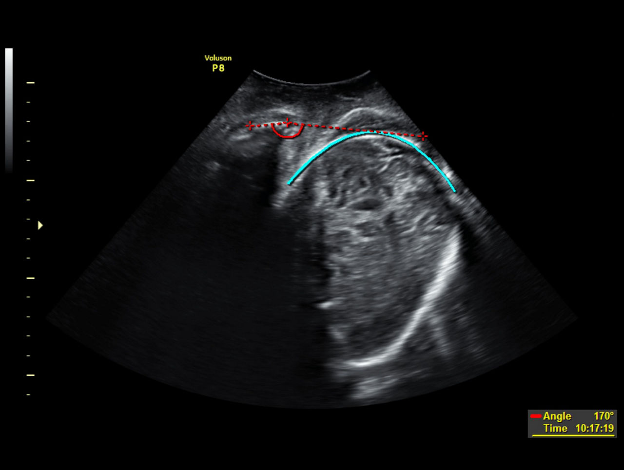 voluson-p8-technology-sono-ld-ci-en