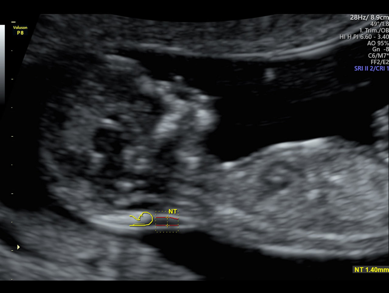 voluson-p8-technology-sono-nt-ci-en