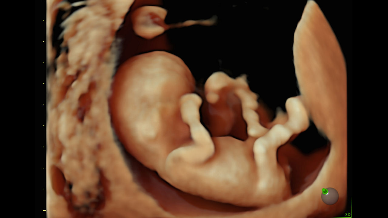 voluson-performance-18-image-quality