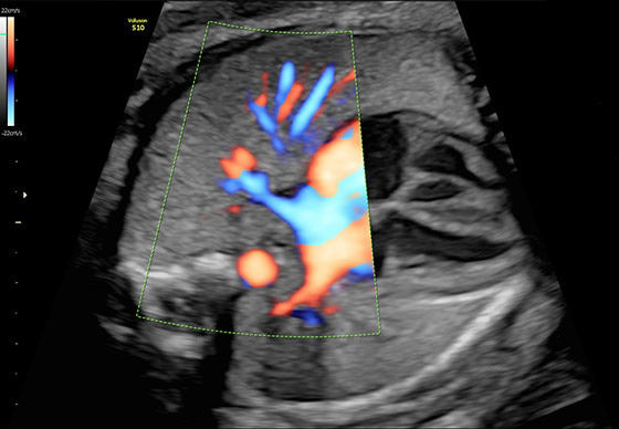 voluson-s10-ultrasound-2d-image-st-en