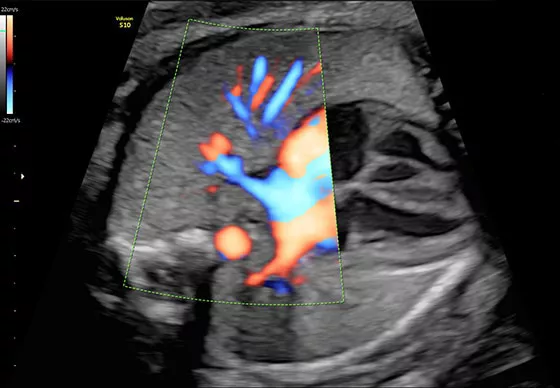 voluson-s10-ultrasound-2d-image-st-en