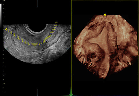 voluson-s8-signature-series-ge-s-curve-advanced-volume-contrast-imaging