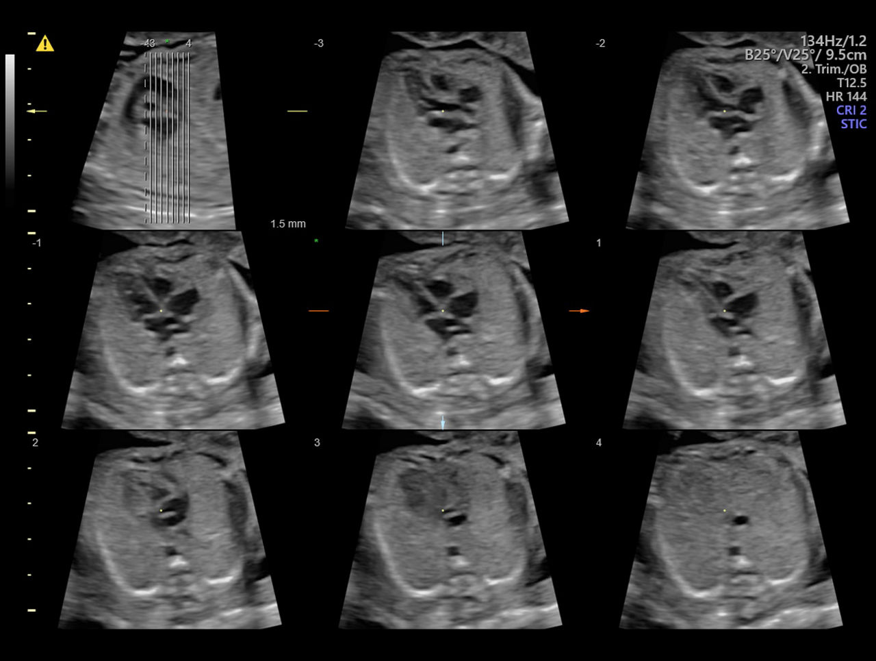 voluson-s8-technology-sonovcad-ci-en