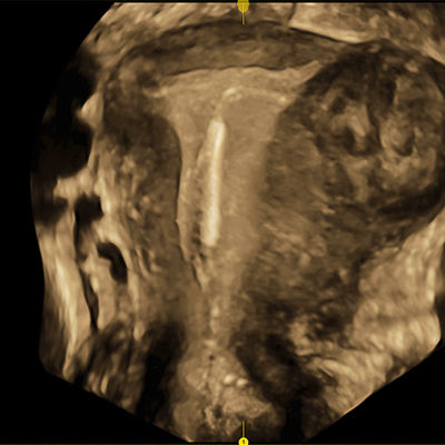 voluson-segment-gynecology
