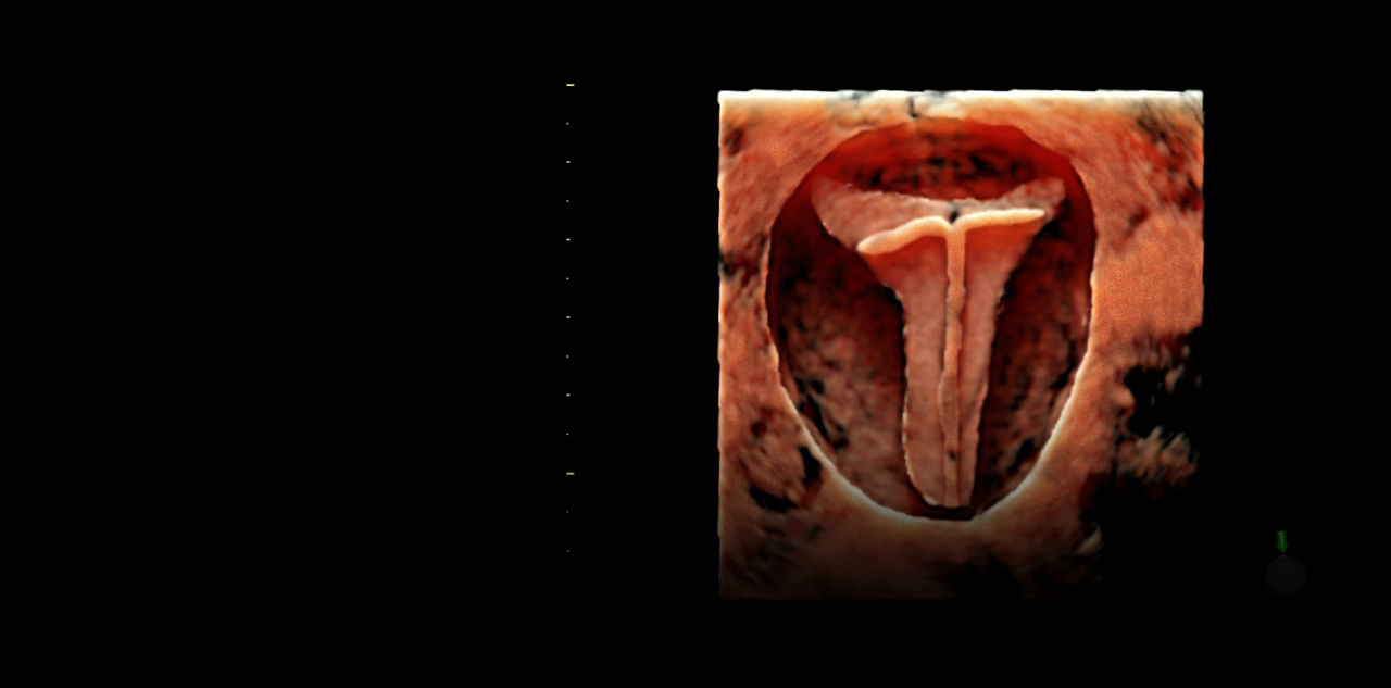 voluson-swift-hdlive-ci-en