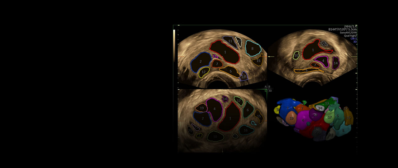voluson-swift-sonovac-gyn-ci-en
