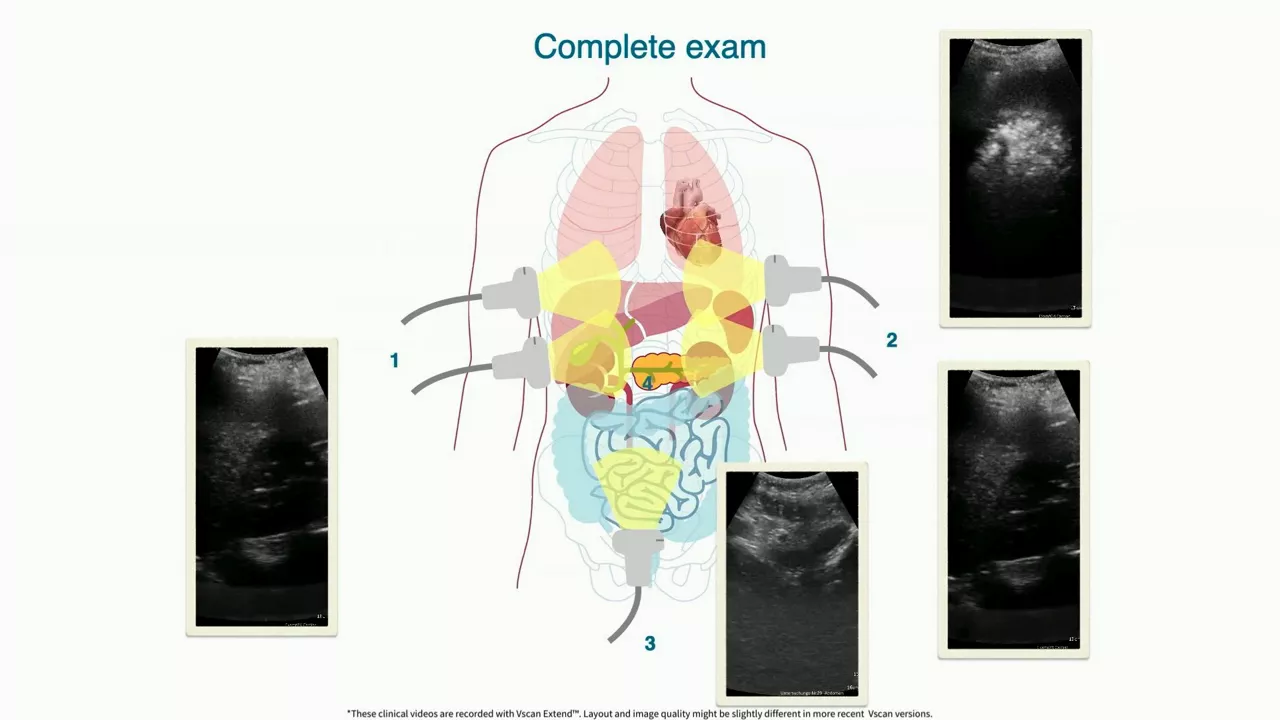 vscan-air-how-to-do-an-efast-exam-in-under-2-minutes