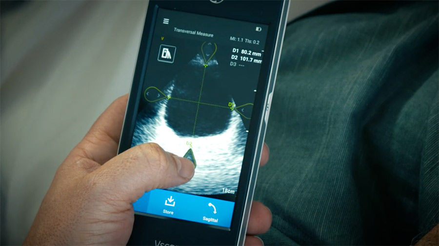 vscan-extend-Bladder-Volume-App