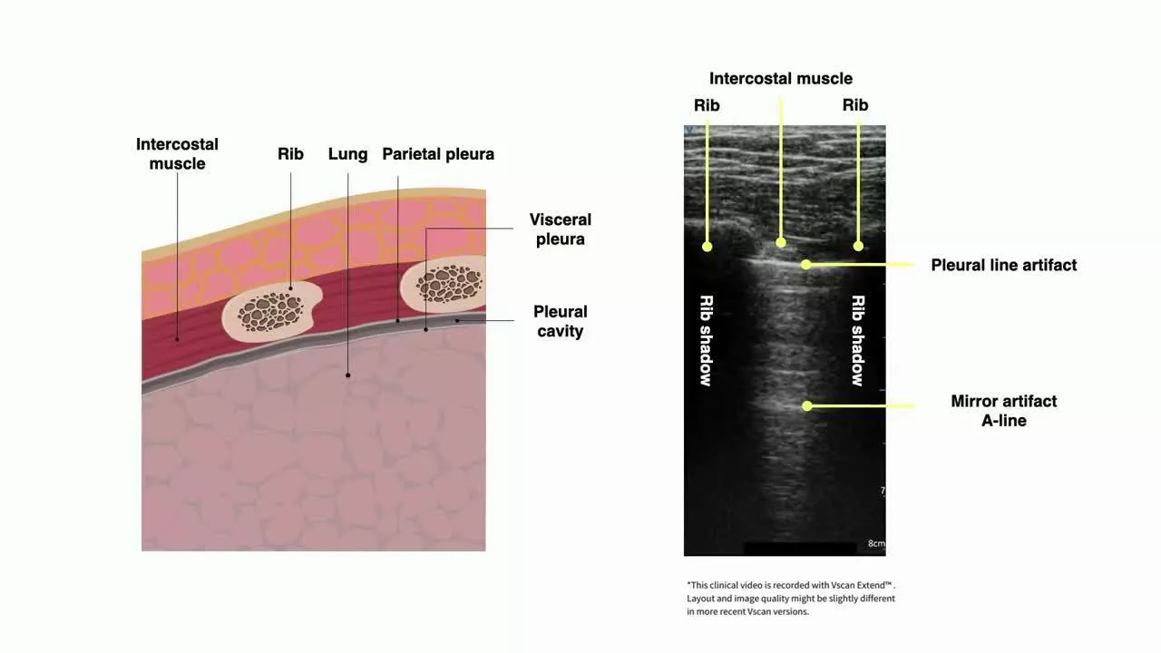 vscan-what-does-a-normal-lung-look-like-in-ultrasound-te-en