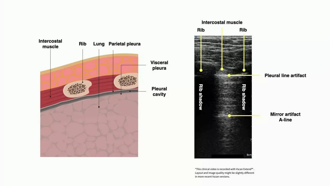vscan-what-does-a-normal-lung-look-like-in-ultrasound