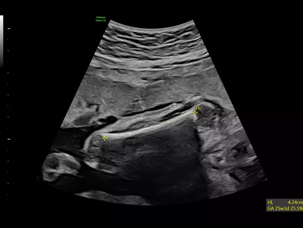workflow-efficiency-clinical-image-of-sonobiometery-st-en