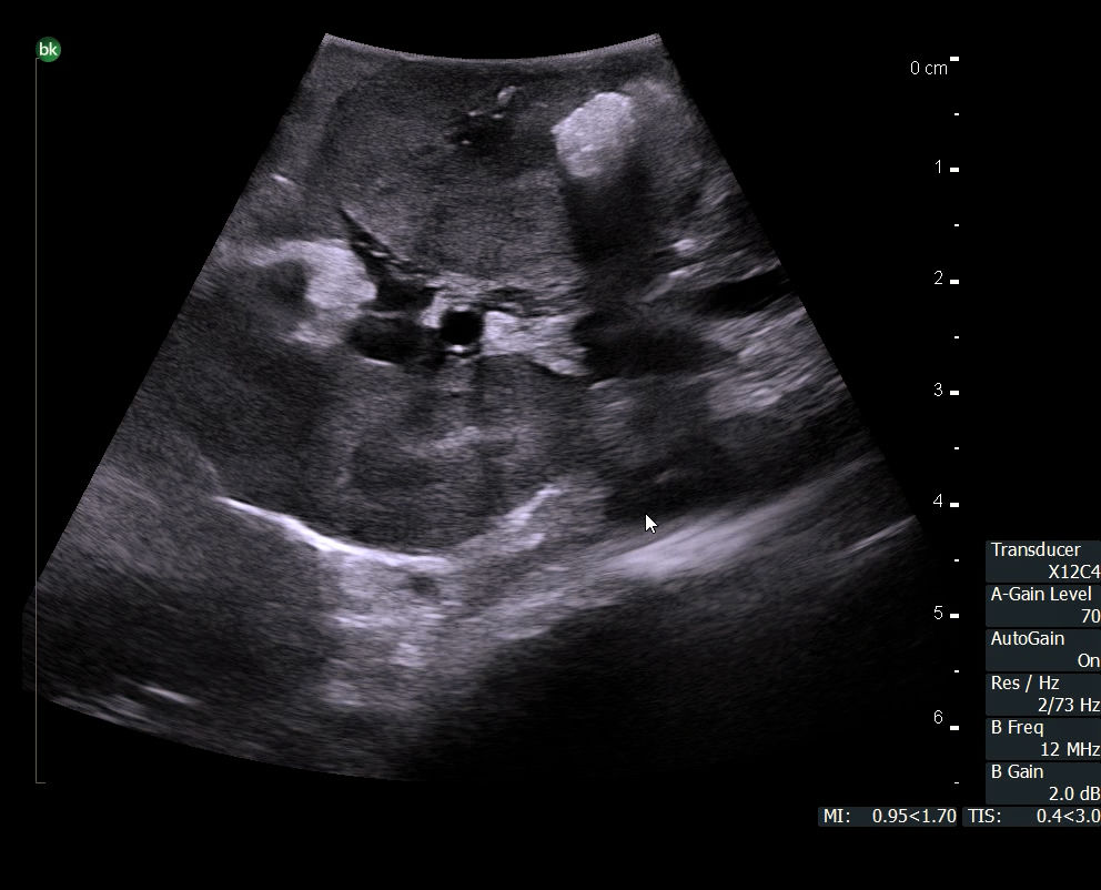 X12C4_renal tumor with stone_7