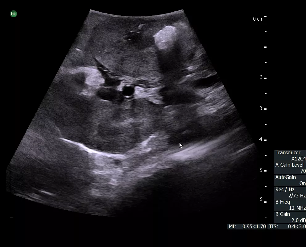 X12C4_renal tumor with stone_7