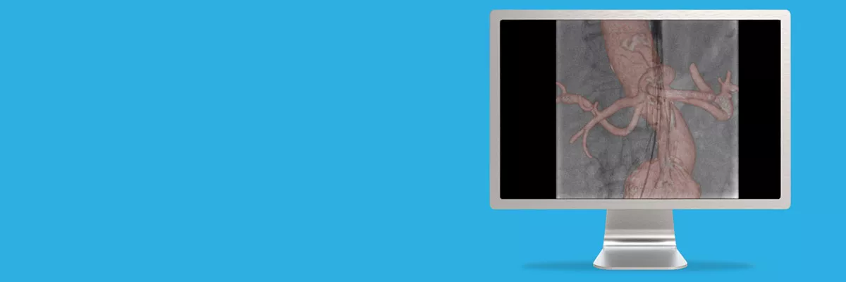 do-not-clone-advanced-visualization-applications-tevar-assist-aw-evar-assist_spotlight.jpg