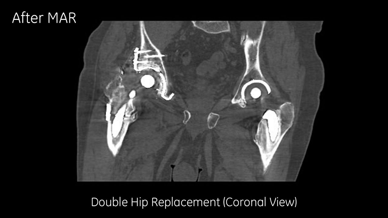 al-artifact-reduction-image-gallery-double-hip-replacement-coronal-view-after-clinical