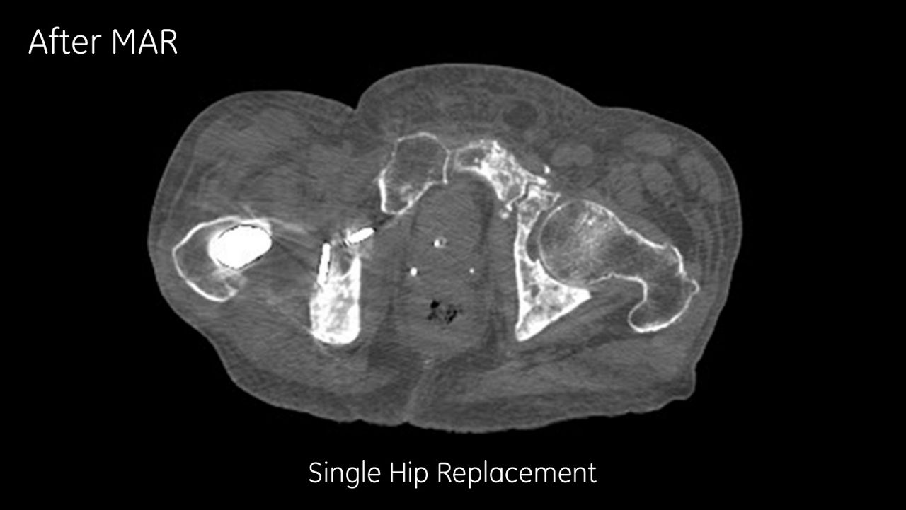 al-artifact-reduction-image-gallery-single-hip-replacement-uncorrected-before-clinical